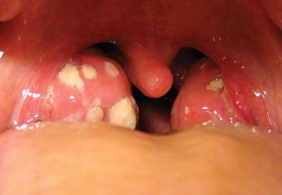 Natural remedies for tonsillitis